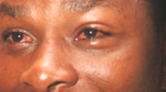 Explainer: Causes and symptoms of red eye disease affecting Coast residents