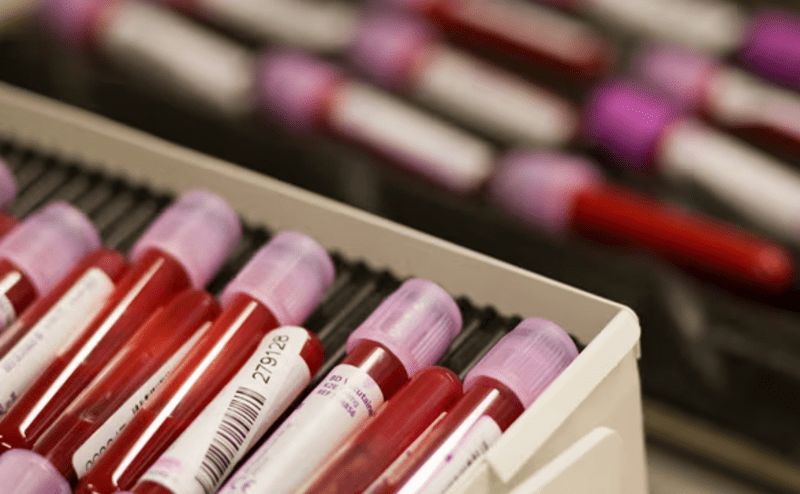 AI-powered blood test may detect Parkinson's disease years before onset