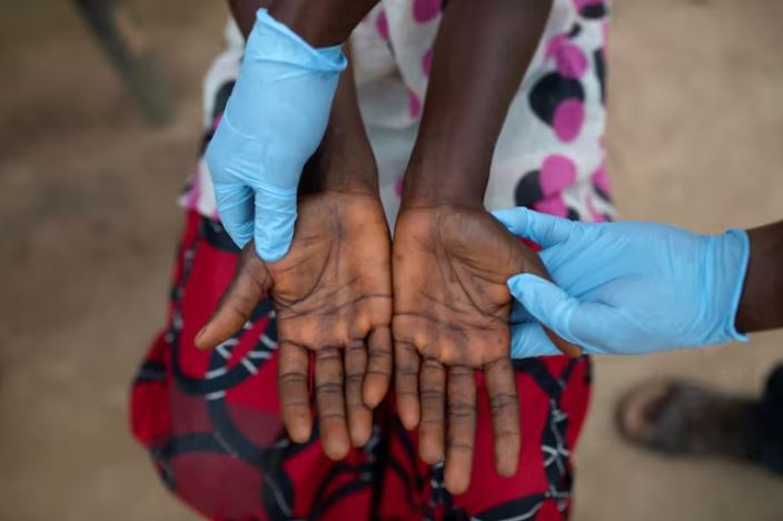 Congo on high alert as new strain of Mpox virus spreads rapidly along eastern border