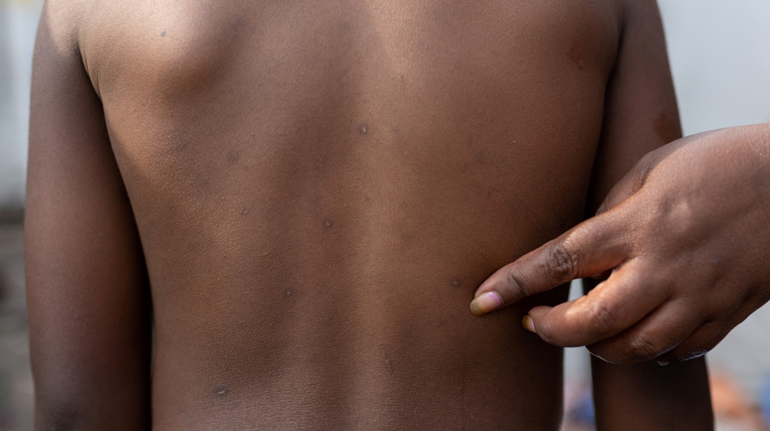 Burundi reports three mpox cases, health ministry says