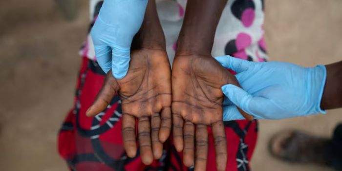 WHO makes urgent appeal as DRC conflict hampers reponse to mpox outbreak