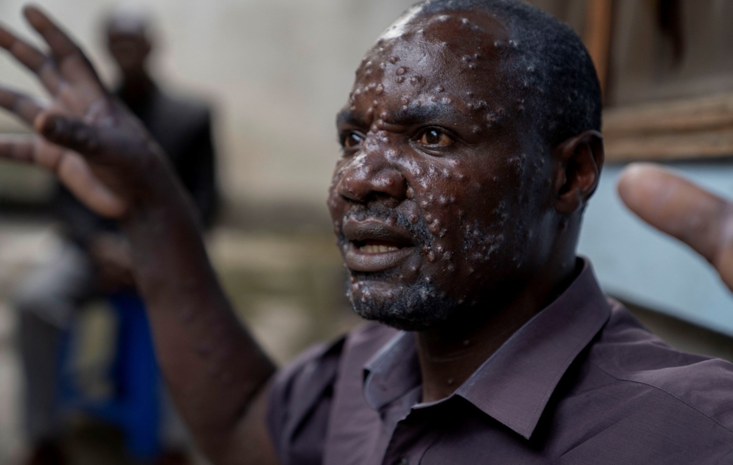 Jean Kakuru Biyambo, 48, a father of six from the Muja internally displaced persons camp, gestures outside his room at the Goma general hospital where he has been receiving treatment against Mpox - an infectious disease caused by the monkeypox virus that spark-off a painful rash, enlarged lymph nodes and fever; following Mpox cases in Nyiragongo territory, in Goma, North Kivu province, Democratic Republic of the Congo July 16, 2024. REUTERS/Arlette Bashizi