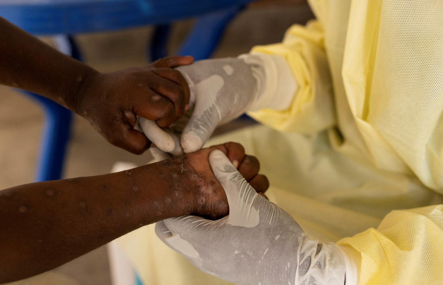 Christian Musema, a laboratory nurse, takes a sample from a child declared a suspected case of Mpox at the treatment centre in Munigi, following Mpox cases in Nyiragongo territory near Goma, North Kivu province, Democratic Republic of the Congo July 19, 2024. (Photo: REUTERS/Arlette Bashizi/File Photo)