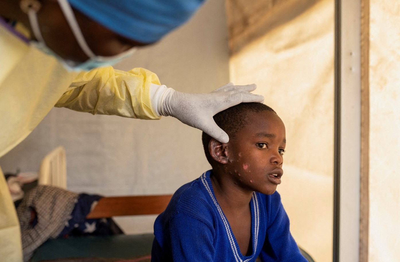 Africa CDC highlights key challenges in containing Mpox outbreak across Africa