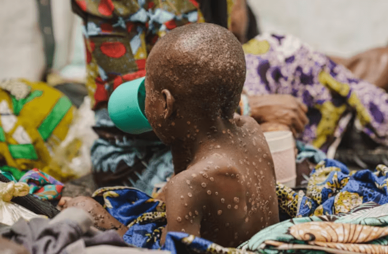 Mpox in the DRC: children are at high risk – health expert explains why