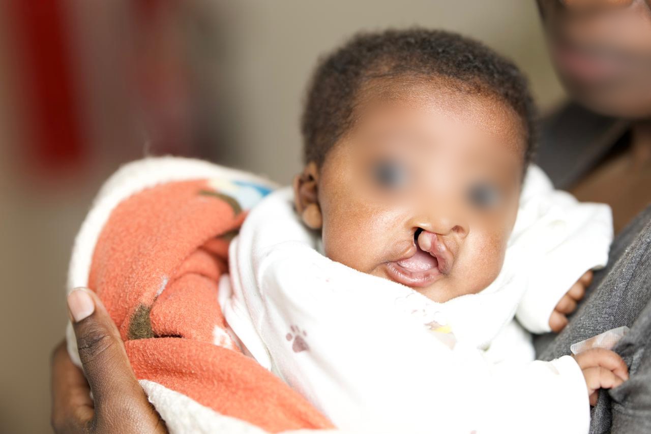 A file image of a baby with a cleft lip. (Photo: Handout)