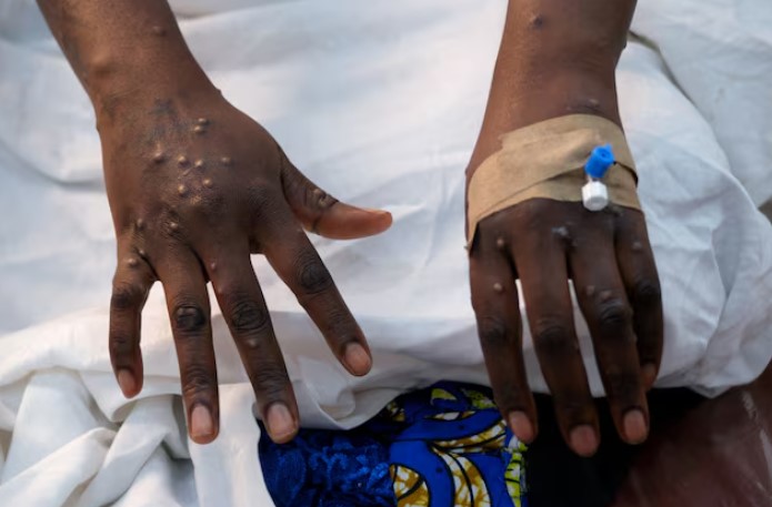 Mpox still a health emergency, says WHO