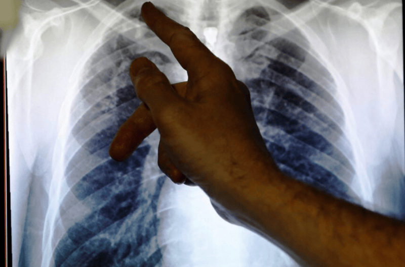 The rising threat of multidrug-resistant tuberculosis in Kenya - Clinical lead Doctor Al Story points to an x-ray showing a pair of lungs infected with TB (tuberculosis) during an interview with Reuters on board the mobile X-ray unit screening for TB in Ladbroke Grove in London January 27, 2014. (Reuters)