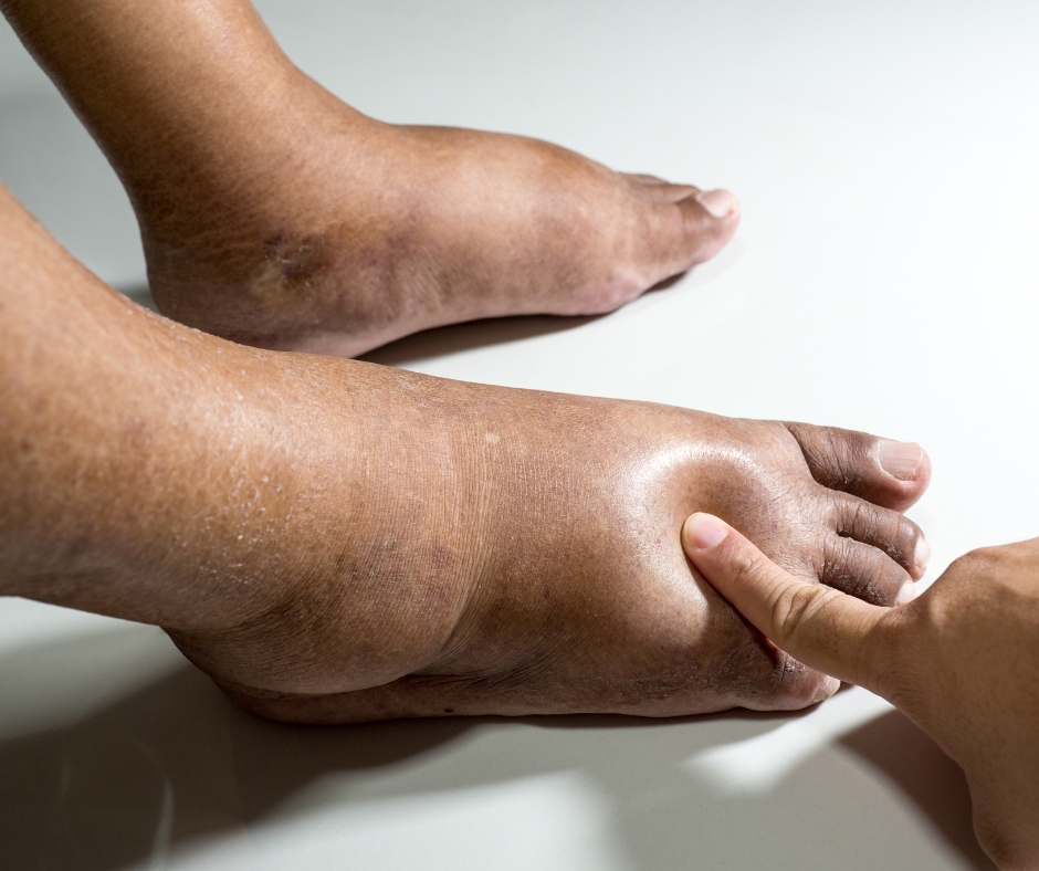 Swollen feet: A common condition that could signal bigger health issues - Persistent swelling in the lower legs, ankles, and feet can be a sign of something far more serious. (Photo: Handout)