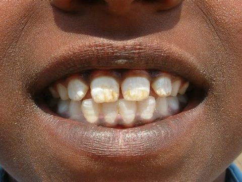 World Oral Health Day: Understanding fluorosis in Kenya