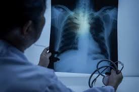 Pneumonia still top killer among Kenyan men as cancer rates surge - report