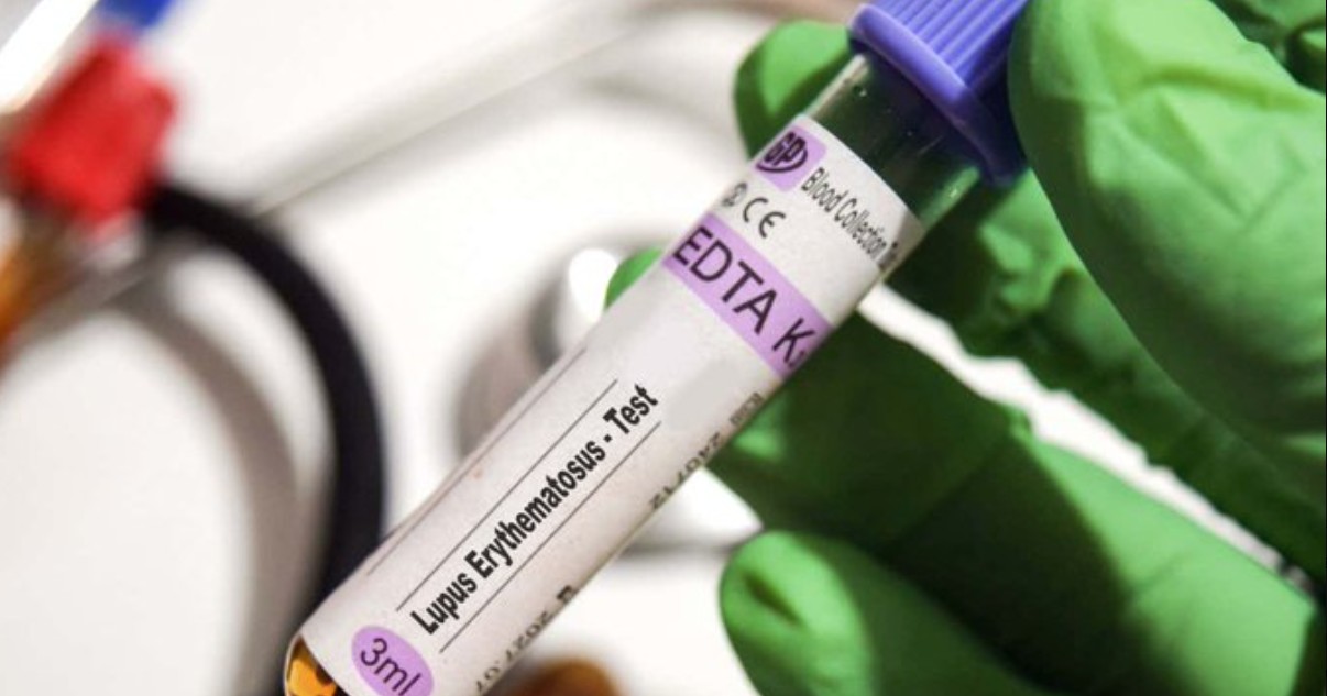 How a common virus may trigger lupus: New insights into the role of Epstein–Barr virus