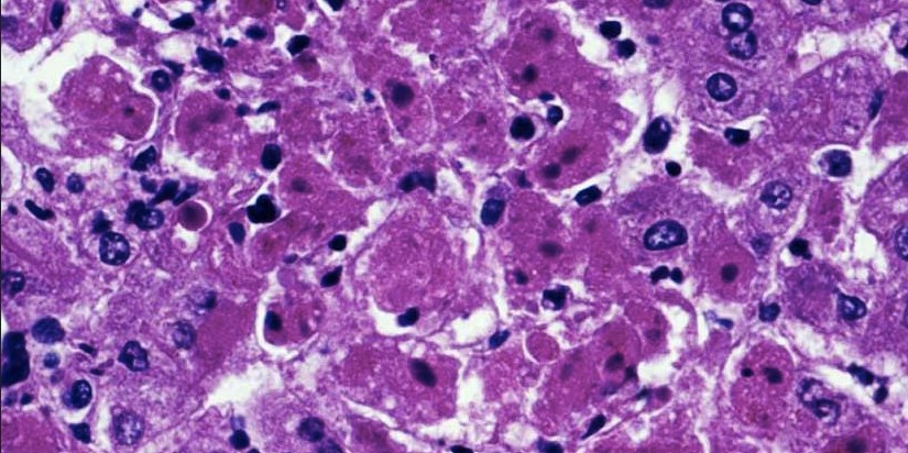 South Sudan on high alert as Marburg outbreak emerges across border in Ethiopia