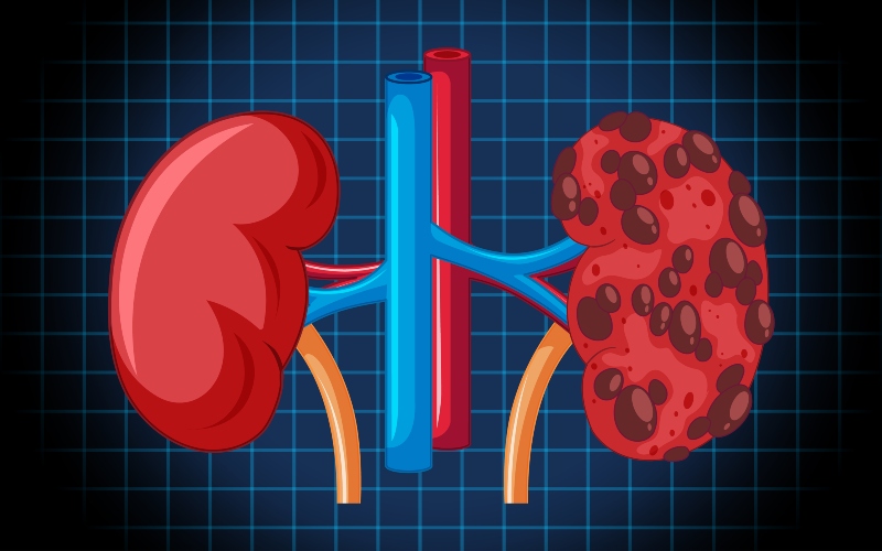 Chronic kidney disease surpasses tuberculosis and colorectal cancer in mortality rankings