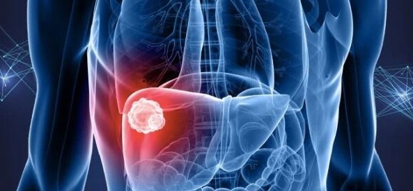 New study shows cutting protein may slow liver cancer growth in people with liver damage
