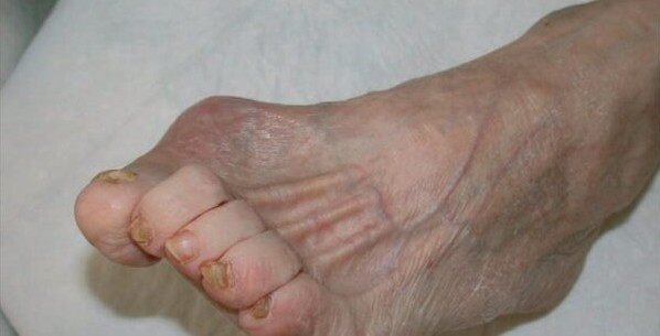Why diabetic wounds refuse to heal: Scientists uncover the immune system breakdown